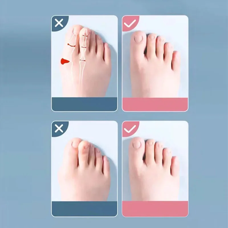 Upgraded Gel 5 finger corrector limited stock available